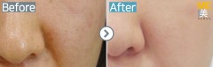 Singapore / Acne scar (Fraxel xena)