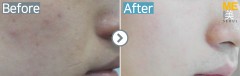 Singapore / Acne scar (Fraxel xena)