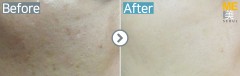 Singapore / Acne scar (Fraxel xena)