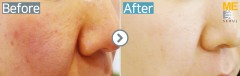 Singapore / Acne scar (Fraxel xena)
