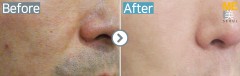 Singapore / Acne scar (Fraxel xena)