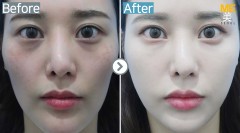 Korea / Anti-Wrinkle (Full Face youth filler)