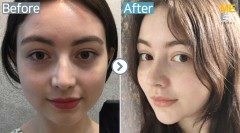 USA / Anti-Wrinkle (Full Face youth filler)