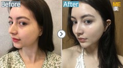 USA / Ultherapy 400 shots, Silhouette soft
threads lifting