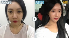 Korea / Ultherapy 400 shots