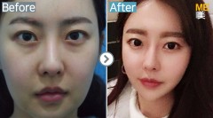 Korea / Ultherapy 400 shots