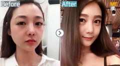Korea / Ultherapy 400 shots