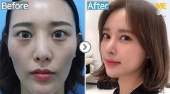Korea / Ultherapy 400 shots