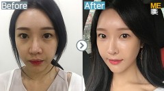 Korea / Rhinoplasty (whole nose,Nose alar reduction)
