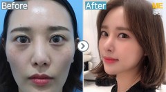 Korea / Rhinoplasty (whole nose,Nose alar reduction)