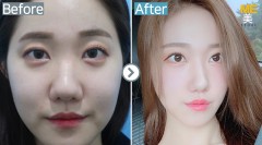 Korea / Rhinoplasty (whole nose,Nose alar reduction )