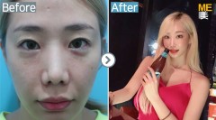 Korea / Anti-Wrinkle (Full Face youth filler)