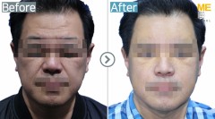Malaysia/ Fat graft (Full face)