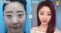 Korea / Rhinoplasty (whole nose,Nose alar reduction)