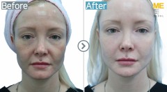 Germany / Ultherapy 600 shots, Restylance